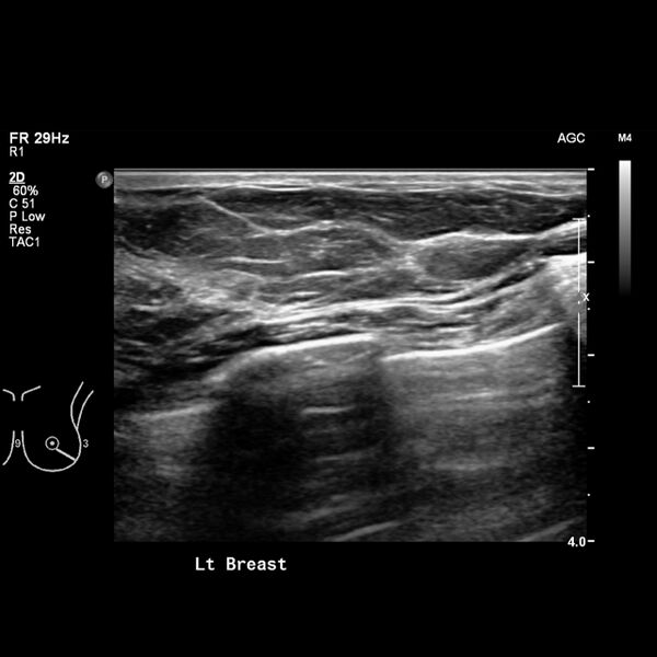 File:Normal breast mammography (tomosynthesis) and ultrasound (Radiopaedia 65325-74354 Left breast 6).jpeg