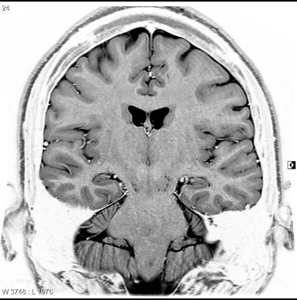 File:Normal coronal brain (Radiopaedia 6676-7910 B 24).jpg