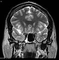Normal coronal brain (Radiopaedia 6676-7910 Coronal T2 13).jpg