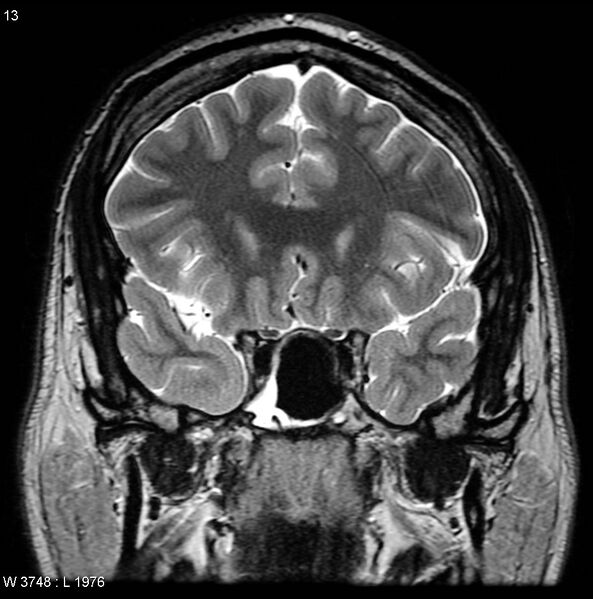 File:Normal coronal brain (Radiopaedia 6676-7910 Coronal T2 13).jpg
