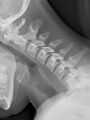 Normal flexion and extension cervical spine x-rays (Radiopaedia 37967-52226 Lateral 1).jpg