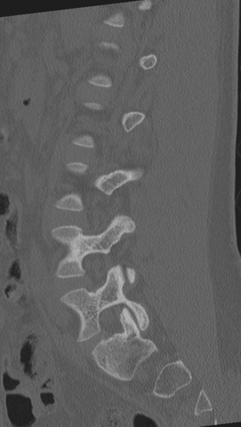 File:Normal lumbar spine CT (Radiopaedia 46533-50986 Sagittal bone window 37).png
