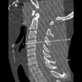 Normal trauma cervical spine (Radiopaedia 41017-43760 Coronal bone window 1).png