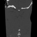 Normal trauma cervical spine (Radiopaedia 41017-43760 Coronal bone window 40).png