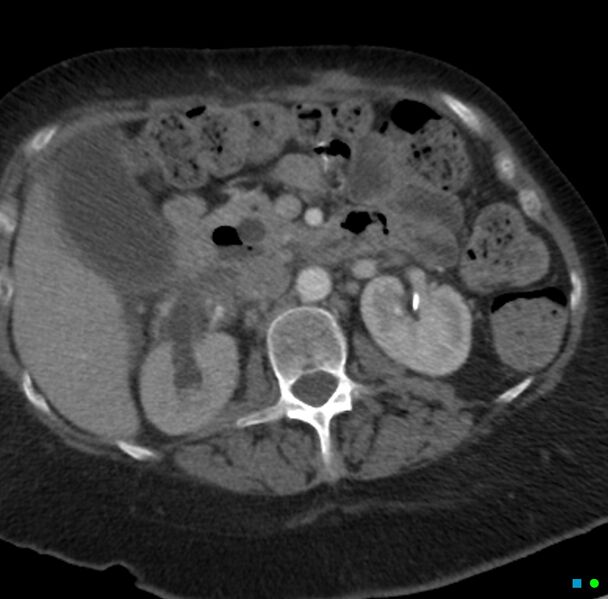 File:Obstructed infected horseshoe kidney (Radiopaedia 18116-17898 B 7).jpg