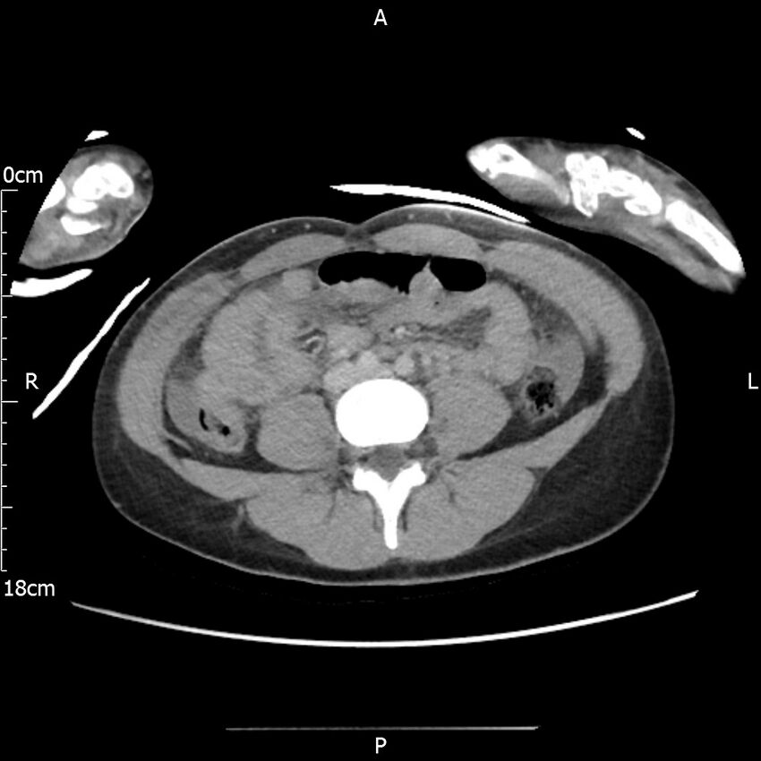 AAST grade IV kidney injury with CEUS follow-up (Radiopaedia 72353-82877 Axial C+ portal venous phase 43).jpg