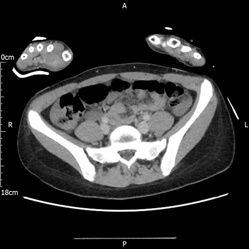 AAST grade IV kidney injury with CEUS follow-up (Radiopaedia 72353-82877 Axial C+ portal venous phase 52).jpg