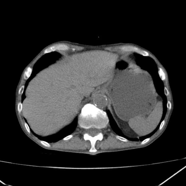 File:Abdominal aortic aneurysm (Radiopaedia 23703-23856 Axial non-contrast 9).jpg