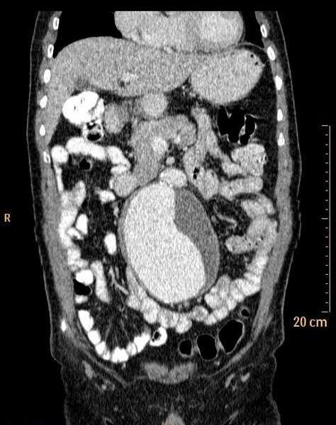 File:Abdominal aortic aneurysm (Radiopaedia 25985-26121 Coronal C+ arterial phase 9).jpg