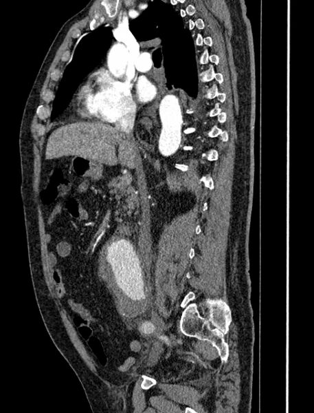 File:Abdominal aortic aneurysm rupture (Radiopaedia 54179-60362 Sagittal C+ arterial phase 17).jpg