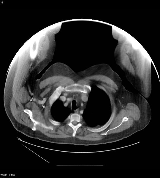 File:Abdominal aortic aneurysm with intramural hematoma then rupture (Radiopaedia 50278-55631 Axial C+ arterial phase 7).jpg