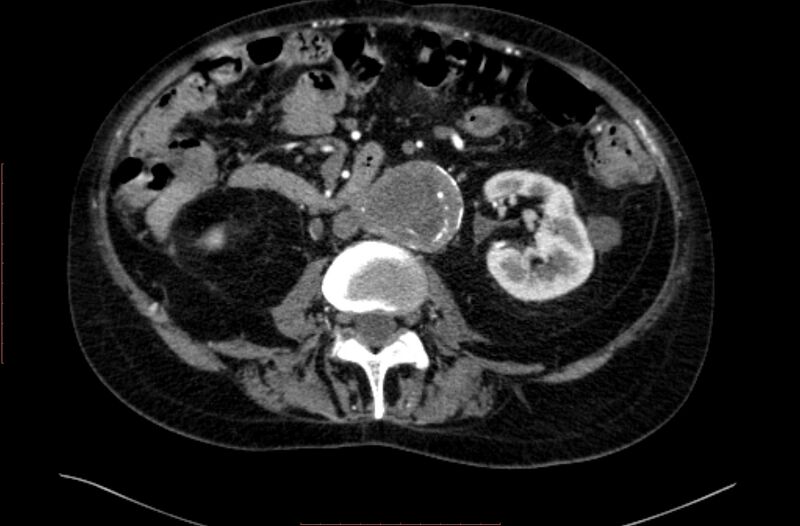 File:Abdominal aortic interposition tube graft and aneurysm thrombosis (Radiopaedia 71438-81857 Axial C+ arterial phase 81).jpg