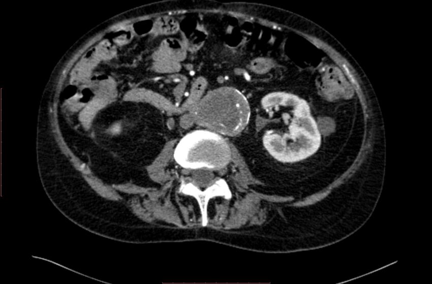 Abdominal aortic interposition tube graft and aneurysm thrombosis (Radiopaedia 71438-81857 Axial C+ arterial phase 81).jpg