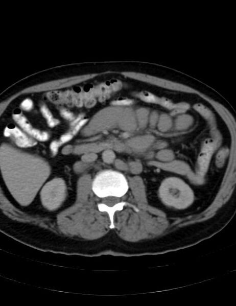 File:Abdominal lymphoma - with sandwich sign (Radiopaedia 53486-59492 Axial C+ portal venous phase 24).jpg