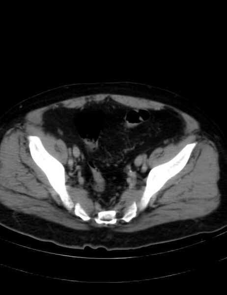 File:Abdominal lymphoma - with sandwich sign (Radiopaedia 53486-59492 Axial C+ portal venous phase 42).jpg