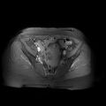 Abdominal wall endometriosis (Radiopaedia 83702-98847 Axial T1 C+ fat sat 24).jpg