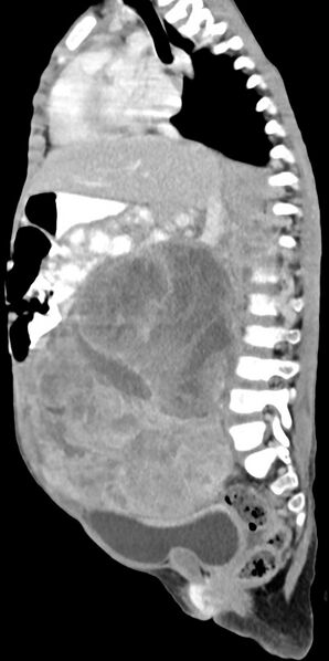 File:Abdominopelvic rhabdomyosarcoma (Radiopaedia 78356-90984 Sagittal C+ portal venous phase 50).jpg