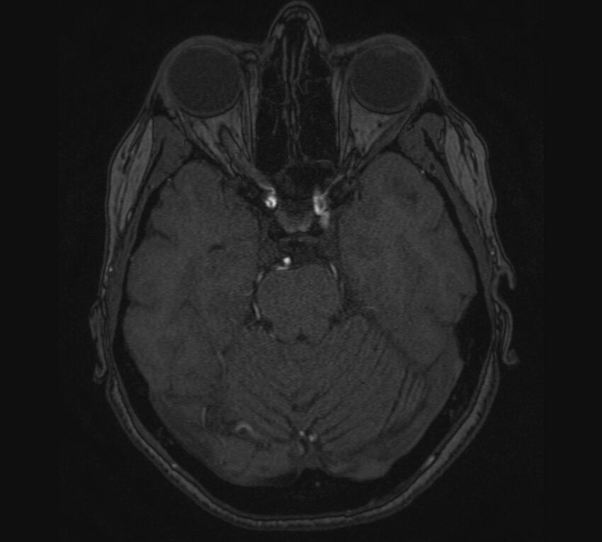 Accessory middle cerebral artery and ICA aneurysm (Radiopaedia 22656-22674 MRA 34).jpg