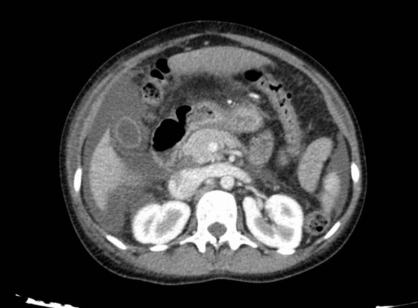 Acute Budd-Chiari syndrome (Radiopaedia 60858-68638 Axial C+ portal venous phase 115).jpg