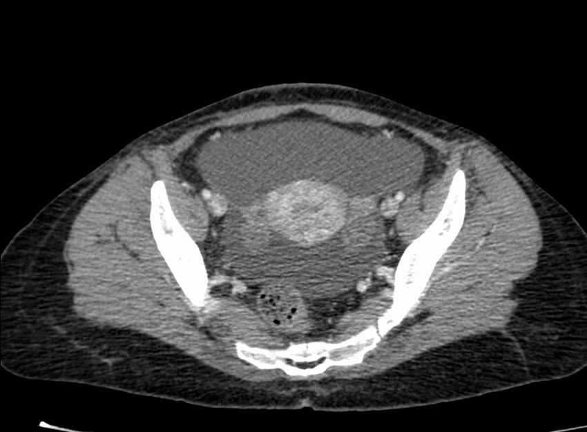 Acute Budd-Chiari syndrome (Radiopaedia 60858-68638 Axial C+ portal venous phase 253).jpg