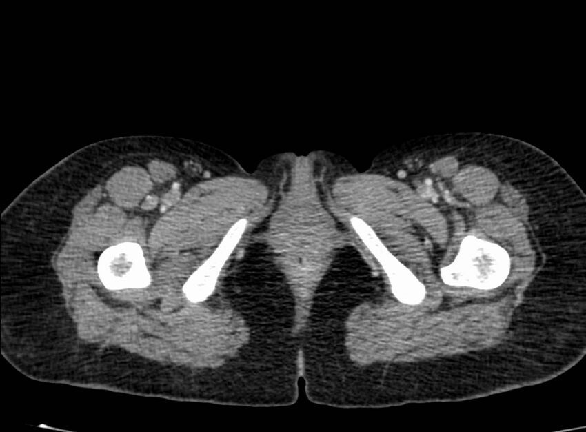 Acute Budd-Chiari syndrome (Radiopaedia 60858-68638 Axial C+ portal venous phase 319).jpg