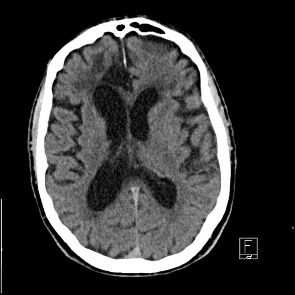 File:Acute ICA ischemic penumbra due to high-grade CCA stenosis (CT perfusion) (Radiopaedia 72038-82529 Axial non-contrast 26).jpg