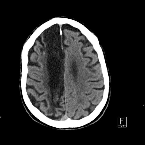 File:Acute ICA ischemic penumbra due to high-grade CCA stenosis (CT perfusion) (Radiopaedia 72038-82529 Axial non-contrast 35).jpg
