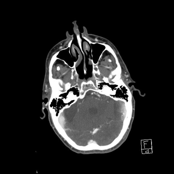 File:Acute ICA ischemic penumbra due to high-grade CCA stenosis (CT perfusion) (Radiopaedia 72038-82530 Axial C+ arterial phase 17).jpg