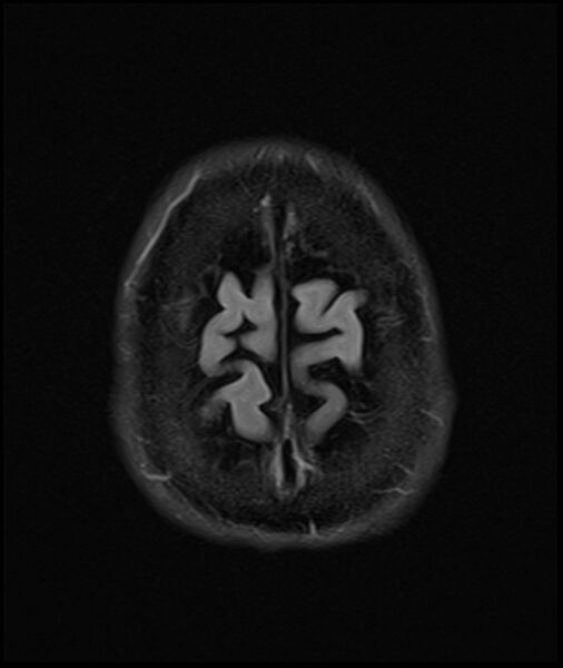 File:Acute P1 occlusion with PCA ischemia penumbra (CT perfusion) (Radiopaedia 72084-82590 Axial FLAIR 35).jpg