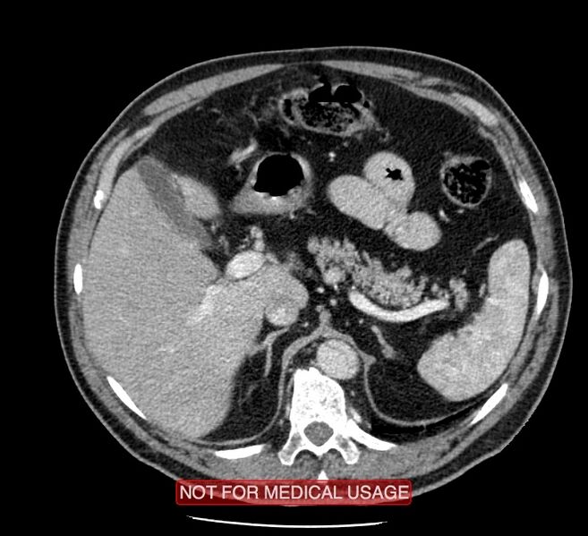 File:Acute aortic dissection - Stanford type A (Radiopaedia 40661-43285 Axial C+ portal venous phase 74).jpg