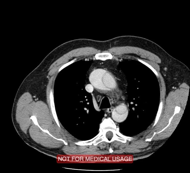 File:Acute aortic dissection - Stanford type A (Radiopaedia 40661-43285 Axial C+ portal venous phase 9).jpg