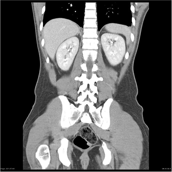 File:Acute appendicitis (Radiopaedia 25364-25615 C+ portal venous phase 24).jpg