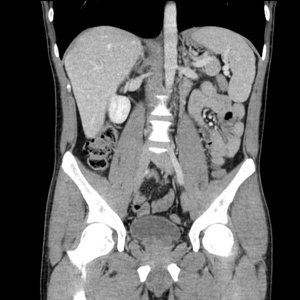 File:Acute appendicitis (Radiopaedia 27049-27227 Coronal C+ portal venous phase 30).jpg