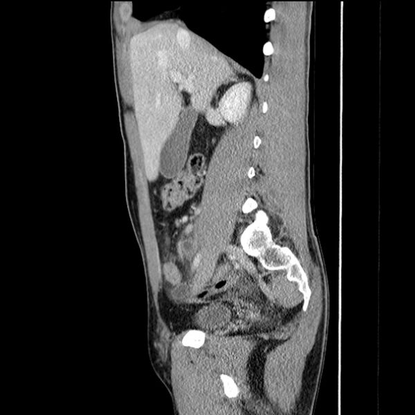File:Acute appendicitis (Radiopaedia 27049-27227 Sagittal C+ portal venous phase 30).jpg