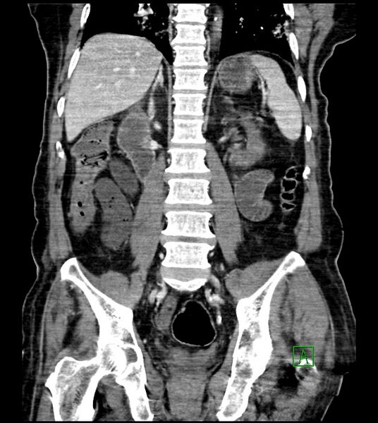 File:Acute arterial mesenteric ischemia (Radiopaedia 78238-90828 Coronal C+ portal venous phase 60).jpg