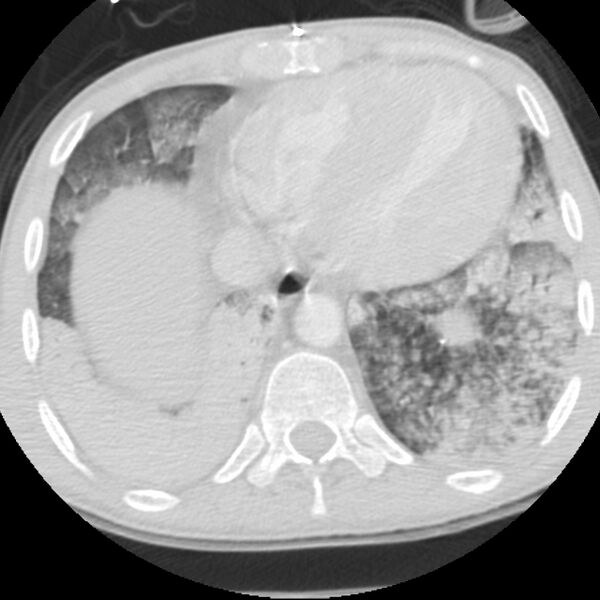 File:Acute diffuse alveolar hemorrhage (Radiopaedia 41323-44158 Axial lung window 50).jpg