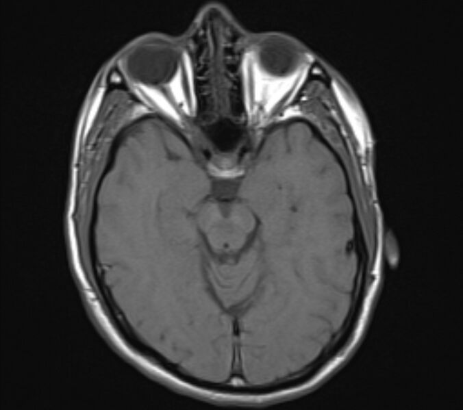File:Acute ischemic stroke - posterior circulation territory (Radiopaedia 77670-89880 Axial T1 10).jpg