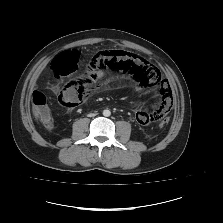 Acute mesenteric ischemia - superior mesenteric artery thrombosis (Radiopaedia 73947-84776 Axial C+ portal venous phase 80).jpg