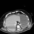 Acute pancreatic necrosis (Radiopaedia 13560-18501 Axial C+ portal venous phase 9).jpg