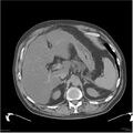 Acute pancreatitis (Radiopaedia 19135-19116 Axial non-contrast 8).jpg