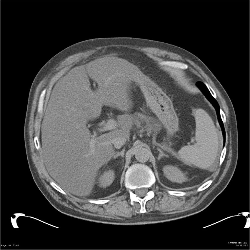Acute pancreatitis (Radiopaedia 19135-19116 Axial non-contrast 8).jpg