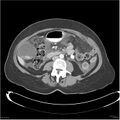 Acute pancreatitis (Radiopaedia 19136-19117 Axial C+ portal venous phase 23).jpg