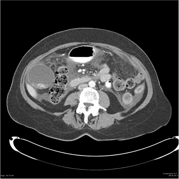 File:Acute pancreatitis (Radiopaedia 19136-19117 Axial C+ portal venous phase 23).jpg