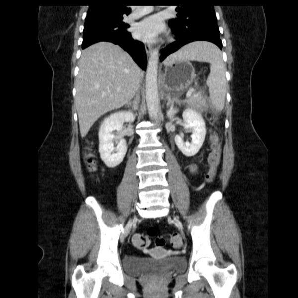 File:Acute pancreatitis - Balthazar C (Radiopaedia 26569-26714 Coronal C+ portal venous phase 41).jpg