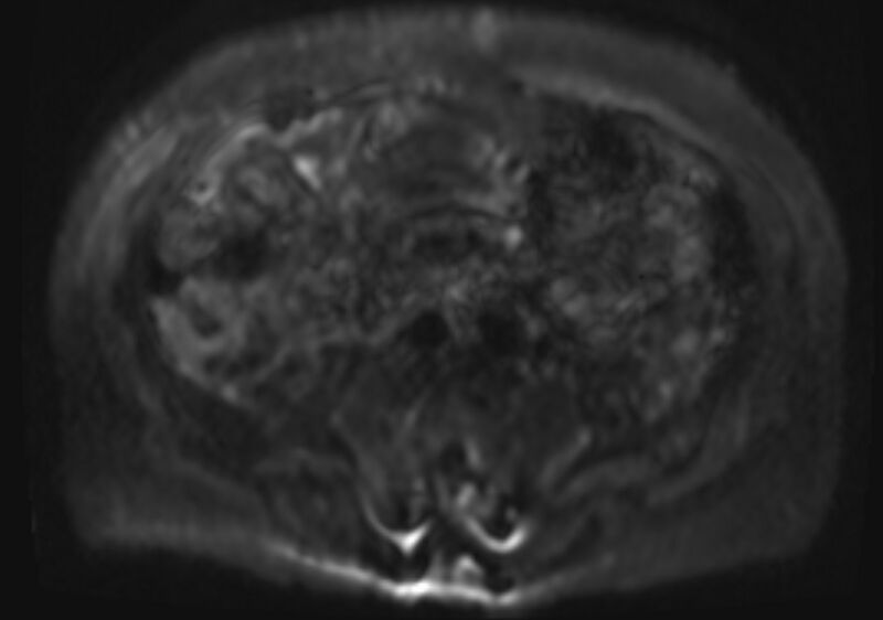 File:Acute portal vein thrombosis (Radiopaedia 73198-83925 Axial DWI 26).jpg