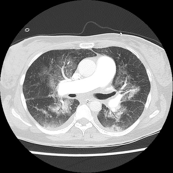 File:Acute pulmonary edema on CT (Radiopaedia 33582-34672 Axial lung window 23).jpg