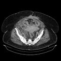 Acute pyelonephritis (Radiopaedia 25657-25837 Axial renal parenchymal phase 65).jpg