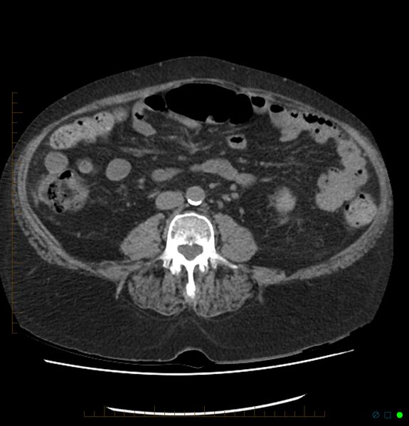 File:Acute renal failure post IV contrast injection- CT findings (Radiopaedia 47815-52557 Axial non-contrast 46).jpg