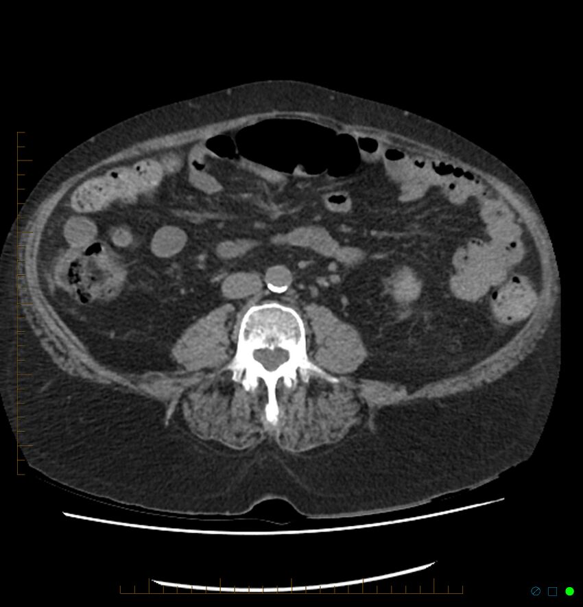 Acute renal failure post IV contrast injection- CT findings (Radiopaedia 47815-52557 Axial non-contrast 46).jpg