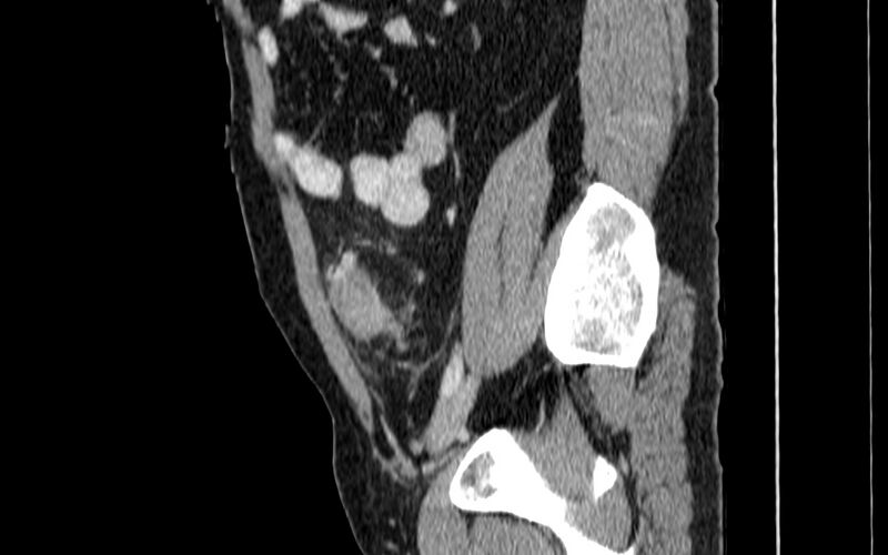 File:Acute sigmoid colon diverticulitis (Radiopaedia 55507-61976 Sagittal C+ portal venous phase 65).jpg